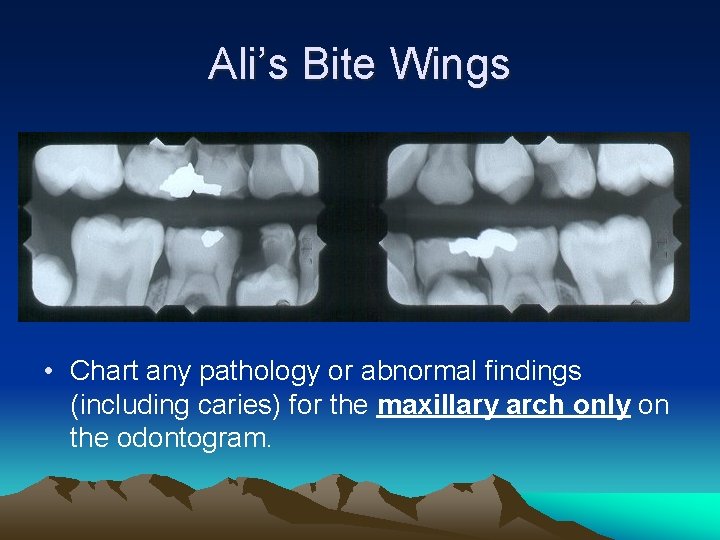 Ali’s Bite Wings • Chart any pathology or abnormal findings (including caries) for the