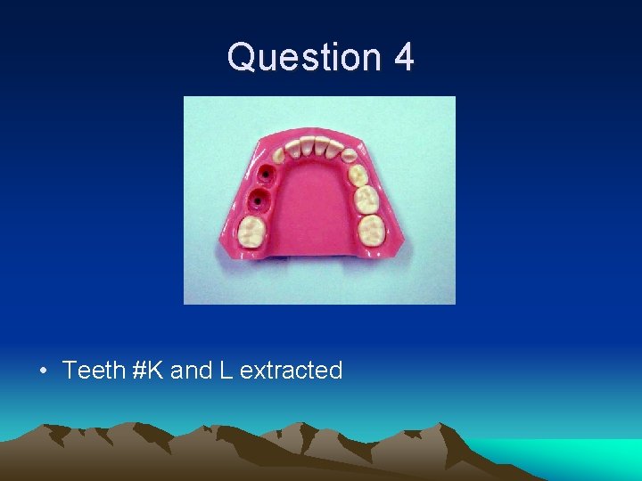 Question 4 • Teeth #K and L extracted 