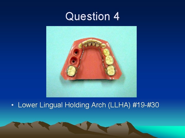Question 4 • Lower Lingual Holding Arch (LLHA) #19 -#30 
