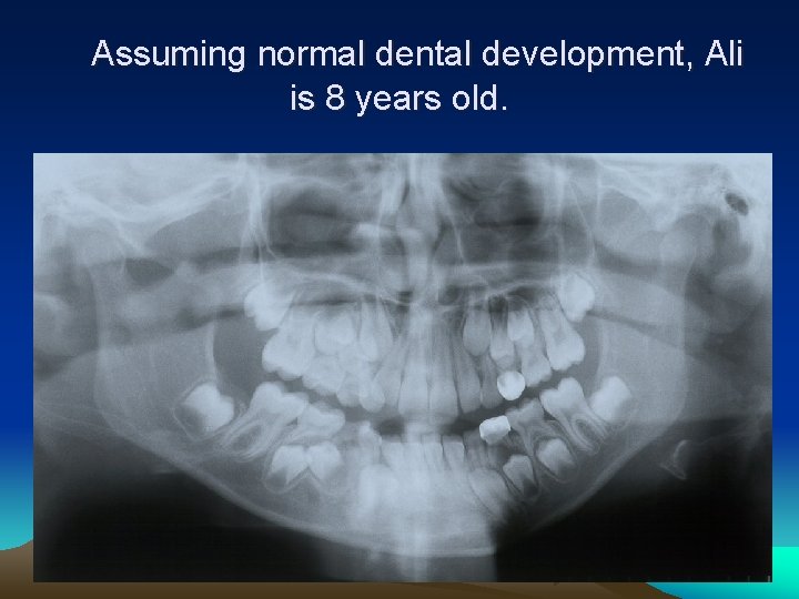 Assuming normal dental development, Ali is 8 years old. 