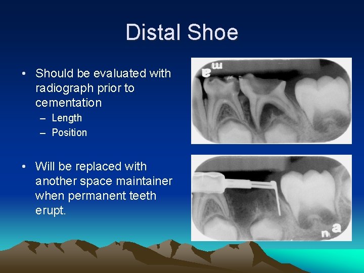Distal Shoe • Should be evaluated with radiograph prior to cementation – Length –