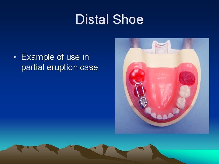 Distal Shoe • Example of use in partial eruption case. 