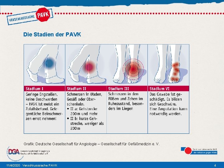Die Stadien der PAVK Grafik: Deutsche Gesellschaft für Angiologie – Gesellschaft für Gefäßmedizin e.
