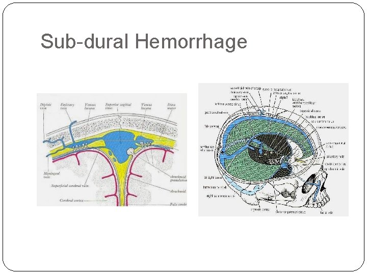 Sub-dural Hemorrhage 