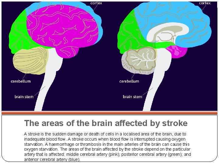 The areas of the brain affected by stroke A stroke is the sudden damage