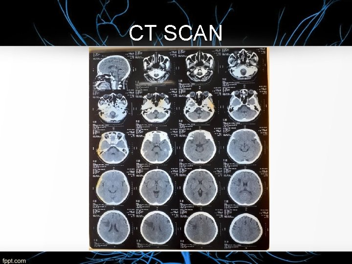 CT SCAN 