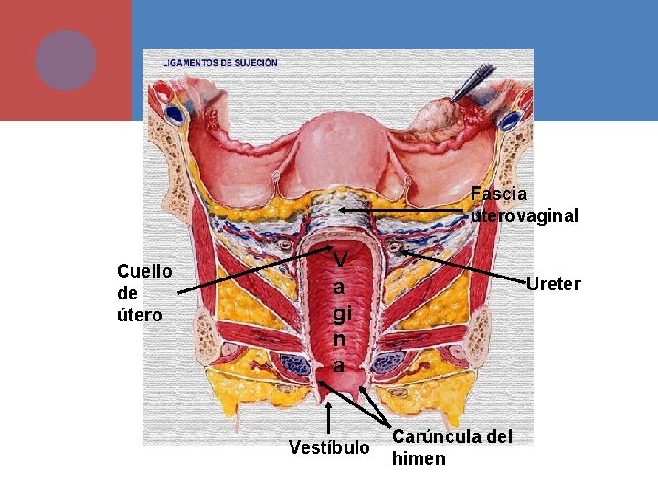 Fascia uterovaginal Cuello de útero V a gi n a Vestíbulo Ureter Carúncula del