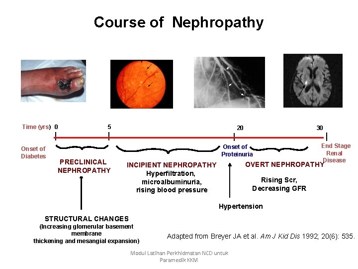 Course of Nephropathy Time (yrs) 0 Onset of Diabetes 5 20 30 Onset of