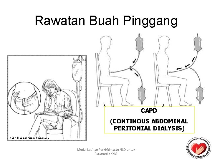 Rawatan Buah Pinggang CAPD (CONTINOUS ABDOMINAL PERITONIAL DIALYSIS) Modul Latihan Perkhidmatan NCD untuk Paramedik