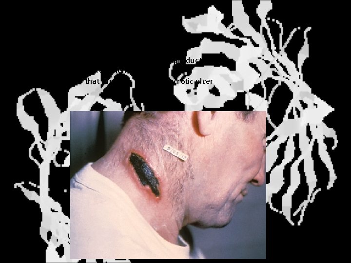 Cutaneous anthrax • • Most common non-intended form Handling of infected animals or animal