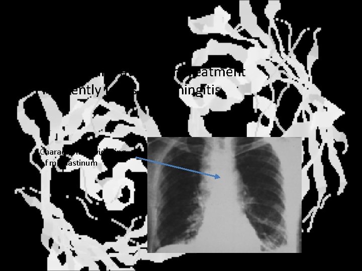 Inhalation anthrax • Inhalation of spores • High lethality even with treatment • Frequently