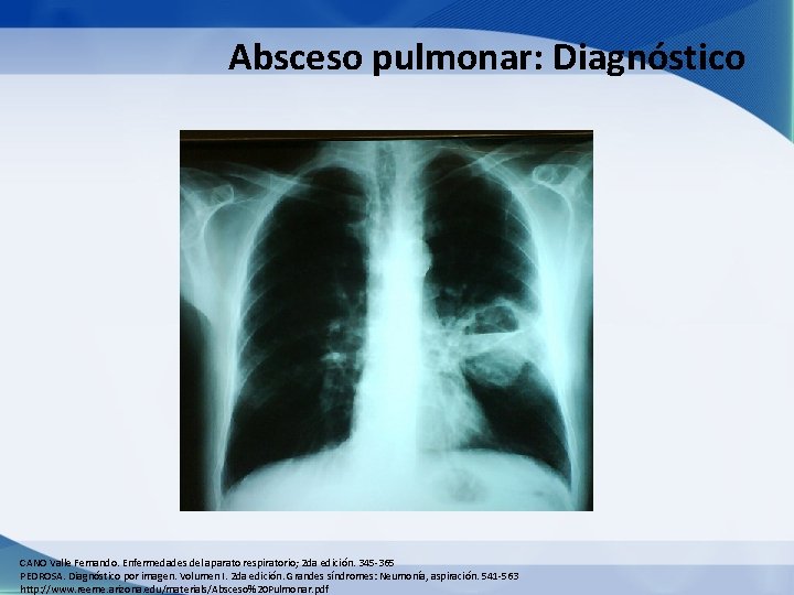 Absceso pulmonar: Diagnóstico CANO Valle Fernando. Enfermedades del aparato respiratorio; 2 da edición. 345