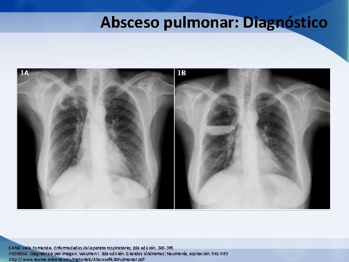 Absceso pulmonar: Diagnóstico CANO Valle Fernando. Enfermedades del aparato respiratorio; 2 da edición. 345