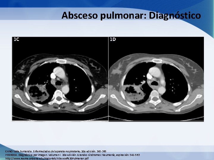 Absceso pulmonar: Diagnóstico CANO Valle Fernando. Enfermedades del aparato respiratorio; 2 da edición. 345