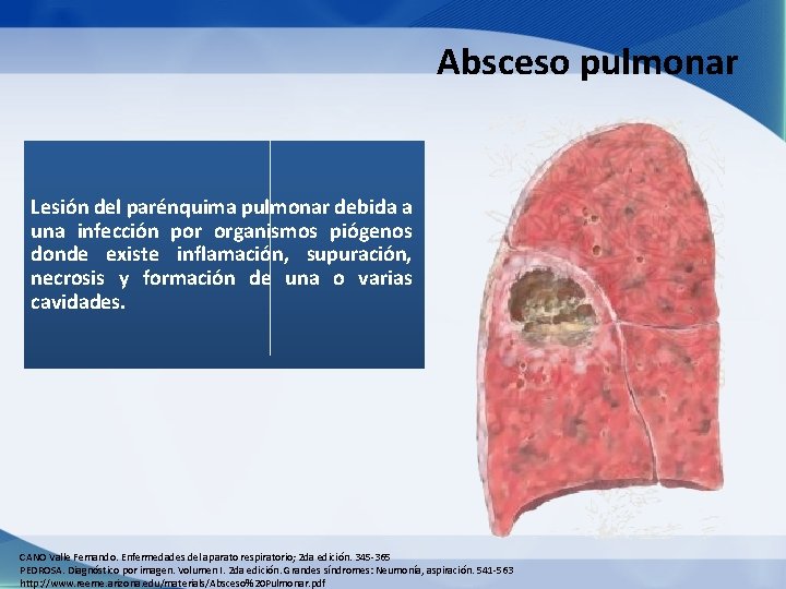 Absceso pulmonar Lesión del parénquima pulmonar debida a una infección por organismos piógenos donde