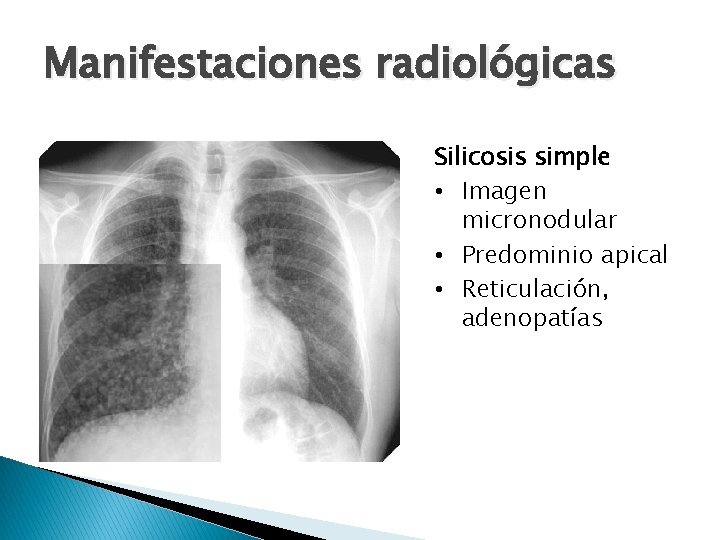 Manifestaciones radiológicas Silicosis simple • Imagen micronodular • Predominio apical • Reticulación, adenopatías 