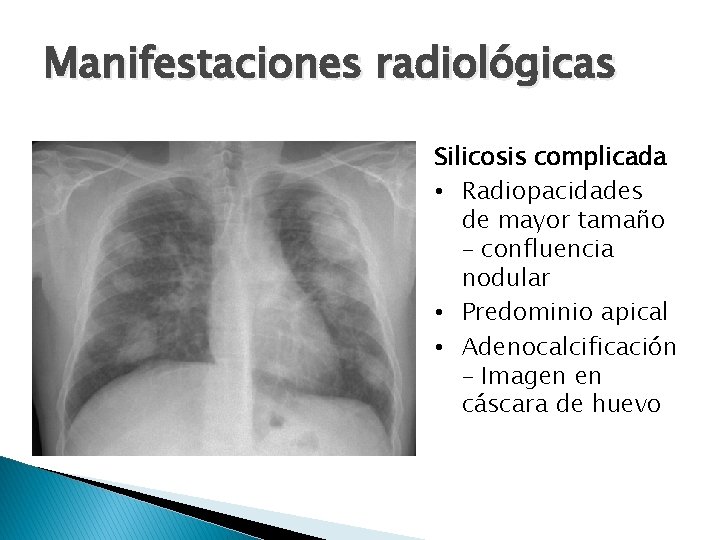 Manifestaciones radiológicas Silicosis complicada • Radiopacidades de mayor tamaño – confluencia nodular • Predominio