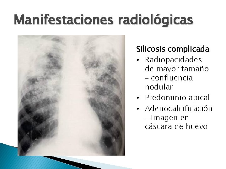 Manifestaciones radiológicas Silicosis complicada • Radiopacidades de mayor tamaño – confluencia nodular • Predominio