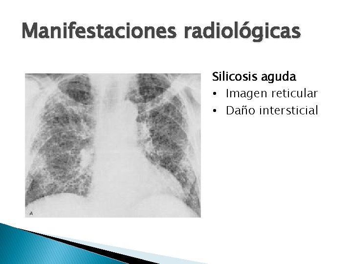 Manifestaciones radiológicas Silicosis aguda • Imagen reticular • Daño intersticial 