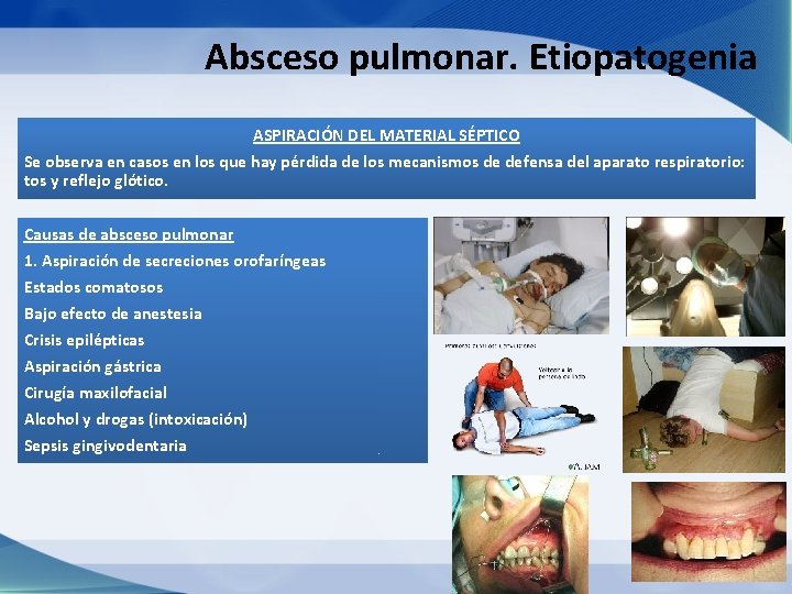 Absceso pulmonar. Etiopatogenia ASPIRACIÓN DEL MATERIAL SÉPTICO Se observa en casos en los que