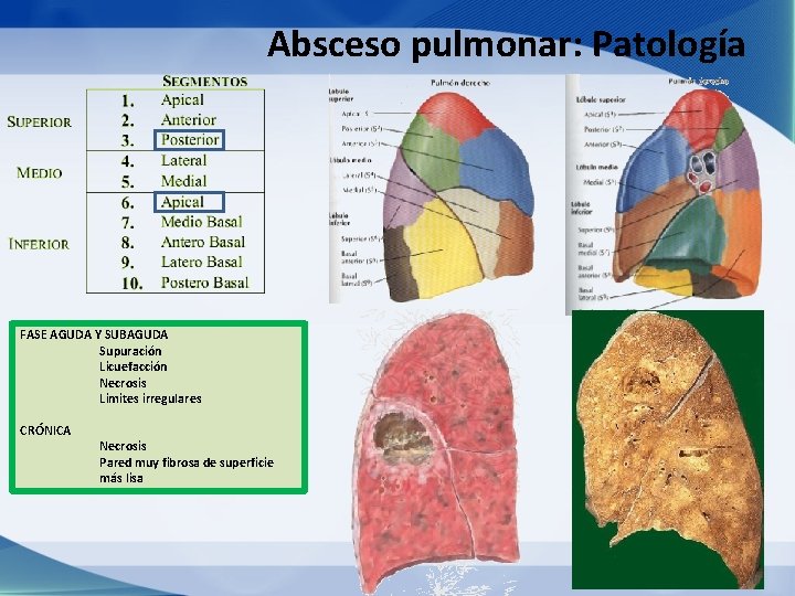 Absceso pulmonar: Patología FASE AGUDA Y SUBAGUDA Supuración Licuefacción Necrosis Limites irregulares CRÓNICA Necrosis