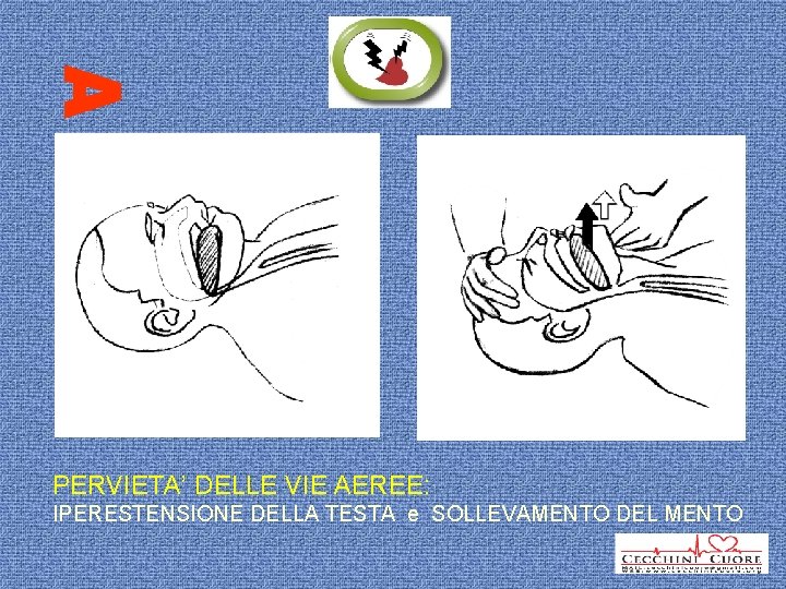 PERVIETA’ DELLE VIE AEREE: IPERESTENSIONE DELLA TESTA e SOLLEVAMENTO DEL MENTO 