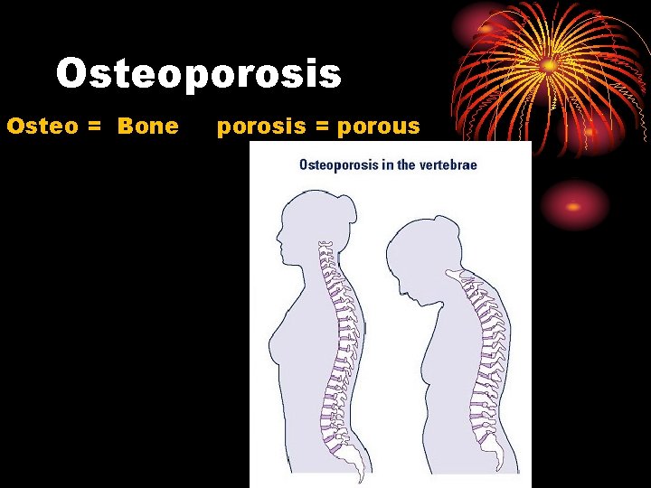 Osteoporosis Osteo = Bone porosis = porous 