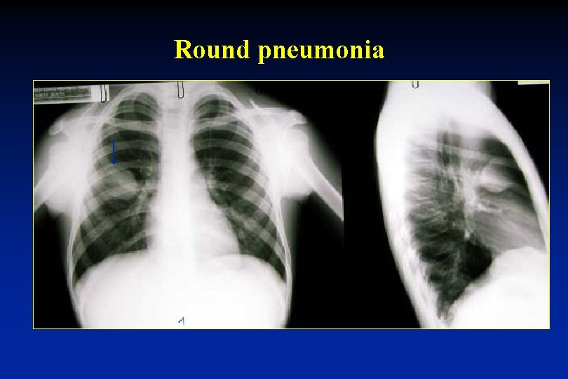 Round pneumonia 
