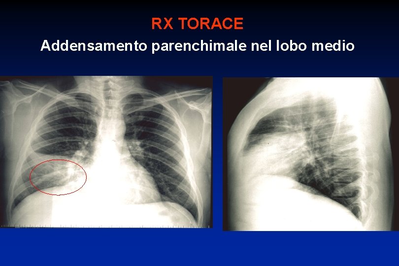 RX TORACE Addensamento parenchimale nel lobo medio 