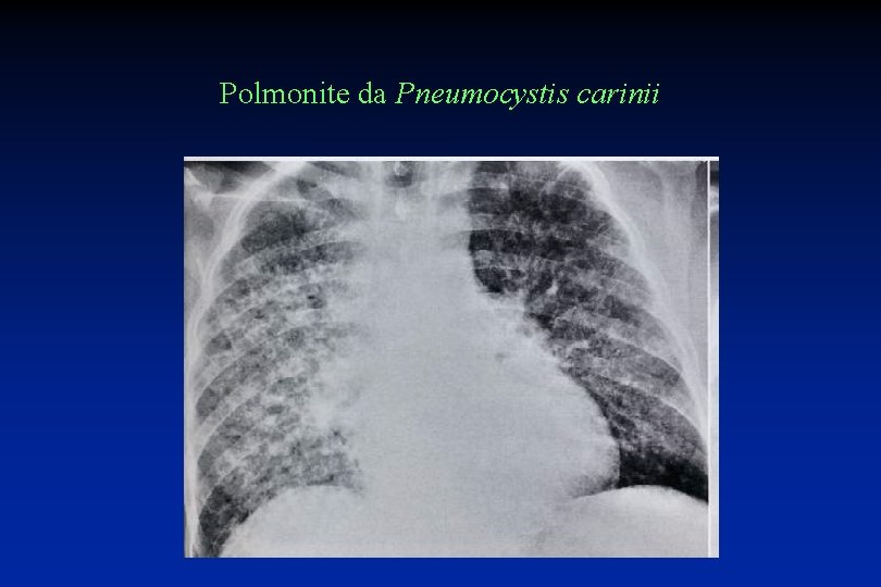 Polmonite da Pneumocystis carinii 