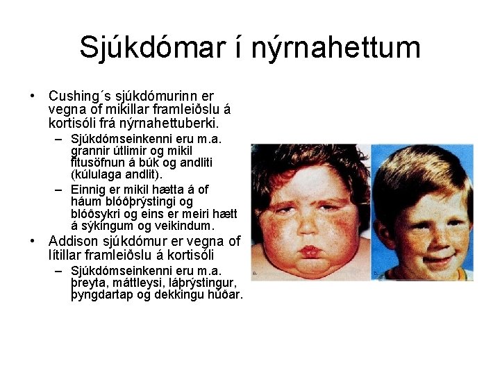 Sjúkdómar í nýrnahettum • Cushing´s sjúkdómurinn er vegna of mikillar framleiðslu á kortisóli frá