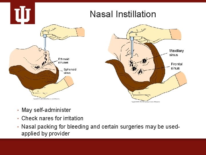 Nasal Instillation • May self-administer • Check nares for irritation • Nasal packing for