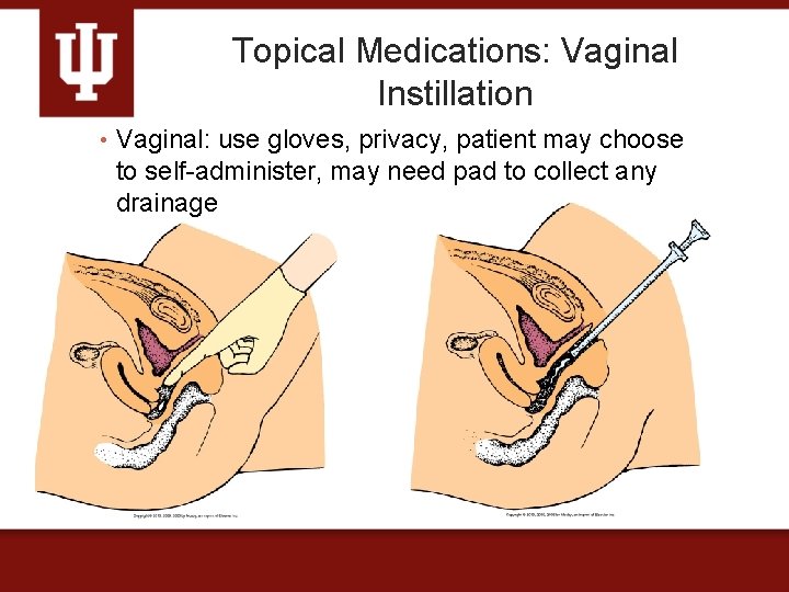 Topical Medications: Vaginal Instillation • Vaginal: use gloves, privacy, patient may choose to self-administer,