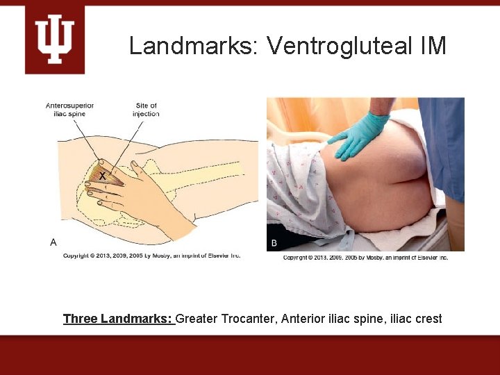 Landmarks: Ventrogluteal IM Three Landmarks: Greater Trocanter, Anterior iliac spine, iliac crest 