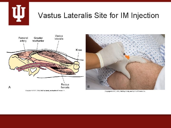 Vastus Lateralis Site for IM Injection 