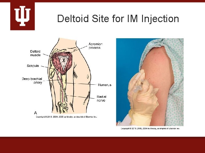 Deltoid Site for IM Injection 