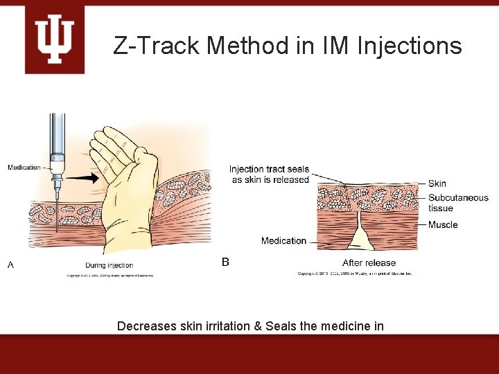 Z-Track Method in IM Injections Decreases skin irritation & Seals the medicine in 