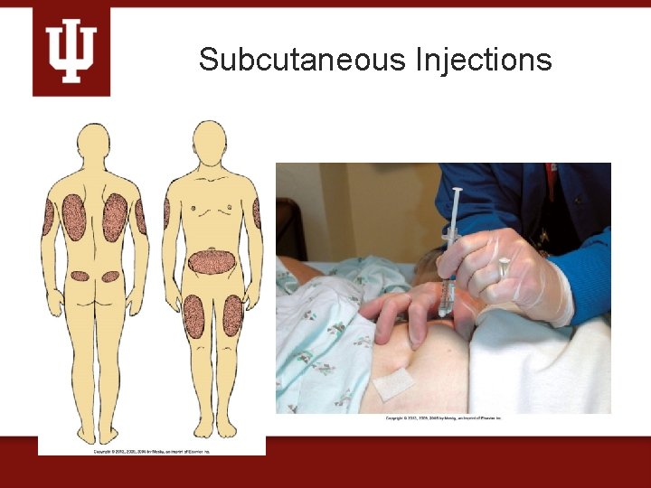 Subcutaneous Injections 