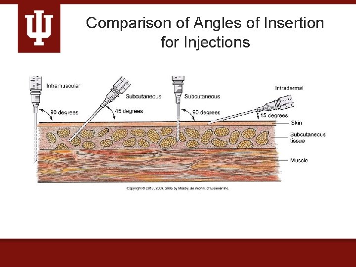 Comparison of Angles of Insertion for Injections 