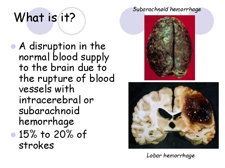 What is it? disruption in the normal blood supply to the brain due to