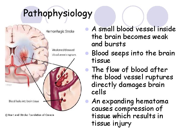 Pathophysiology A small blood vessel inside the brain becomes weak and bursts l Blood