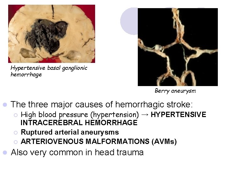 Hypertensive basal ganglionic hemorrhage Berry aneurysm l The three major causes of hemorrhagic stroke: