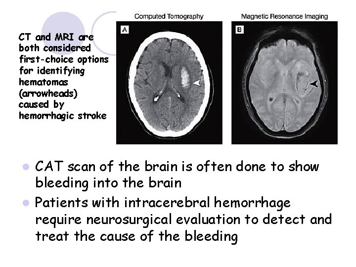 CT and MRI are both considered first-choice options for identifying hematomas (arrowheads) caused by
