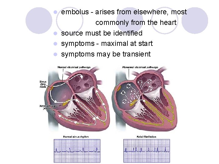 embolus - arises from elsewhere, most commonly from the heart l source must be