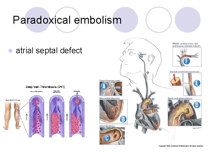 Paradoxical embolism l atrial septal defect 