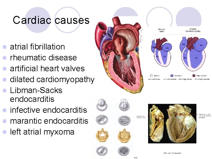 Cardiac causes l l l l atrial fibrillation rheumatic disease artificial heart valves dilated