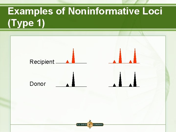 Examples of Noninformative Loci (Type 1) Recipient Donor Examples of Noninformative Loci (Type 1) Recipient Donor