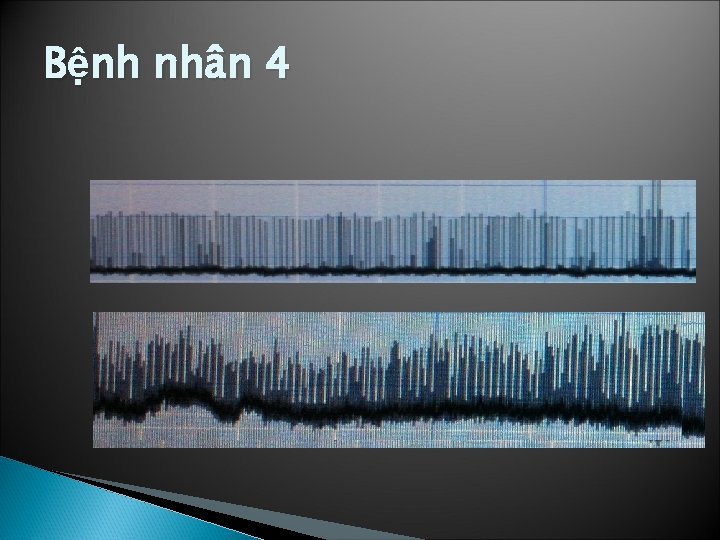 Bệnh nhân 4 