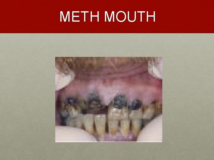 METH MOUTH 
