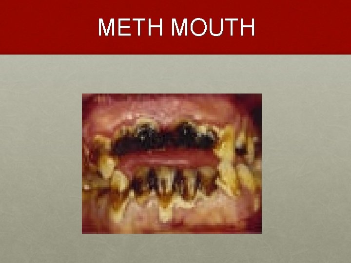 METH MOUTH 